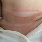 孕妇怎么预防胎儿湿疹（怀孕了长湿疹怎么办）