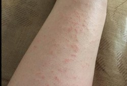 孕妇腿上起红疙瘩还很痒要怎么办,孕期大腿痒是怎么回事