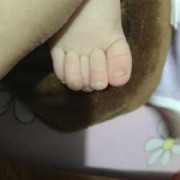 胎儿脚趾畸形（胎儿脚趾畸形）