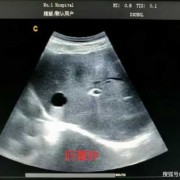 肝囊肿是怎么回事啊？是乙肝引起的吗,胎儿肝内囊肿怎么办