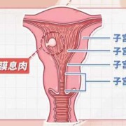 孕期宫颈息肉怎么办,孕期子宫息肉注意事项