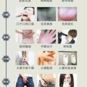 孕期湿气太重怎么除（孕期湿气太重怎么除湿）