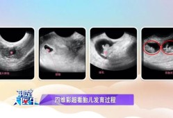 胎儿几个月查畸形（怀孕四个月做唐氏筛查，可以查出胎儿的智商与畸形是不是正常吗）