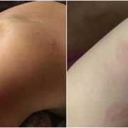 有荨麻疹能不能怀孕生小孩,荨麻疹对胎儿影响大吗