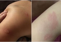 有荨麻疹能不能怀孕生小孩,荨麻疹对胎儿影响大吗