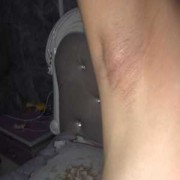 怀孕期间腋窝下有硬块（掖窝下有肿块是怎么回事）