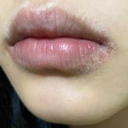 孕妇过敏对胎儿有影响吗（孕初期，嘴唇像过敏对胎儿有没有影响）