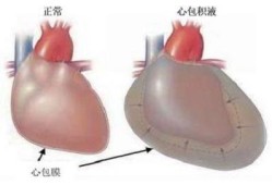 胎儿心包腔少量积液（心包少量积液是怎么回事）