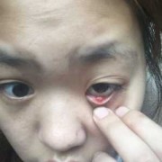 孕期眼睛肿（孕妇眼睛上长了个麦粒肿，这是上火的原因吗）