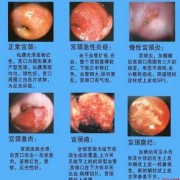 孕期宫颈息肉怎么办,孕期宫颈炎会影响胎儿发育吗