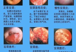 孕期宫颈息肉怎么办,孕期宫颈炎会影响胎儿发育吗