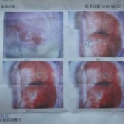 怀孕后期孕妇有宫颈糜烂可以治疗吗，怎么治,孕妇宫颈糜烂对胎儿有影响吗视频
