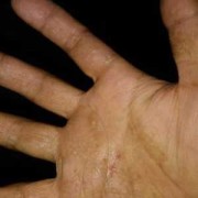 孕期手上起了湿疹怎么办（手上长湿疹怎么办）