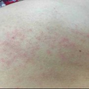 孕期肚皮痒怎么回事（孕期肚皮痒怎么回事长红颗粒）