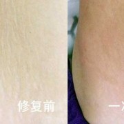 孕期长妊娠纹痒怎么办（孕妇妊娠纹痒可以涂炉甘石吗）