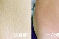 孕期长妊娠纹痒怎么办（孕妇妊娠纹痒可以涂炉甘石吗）