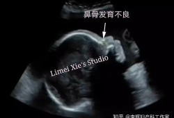 12周胎儿鼻骨缺失是畸形吗,胎儿鼻骨缺失是畸形吗图片