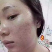 孕期长斑长痘（孕期长斑长痘一定是男孩吗）