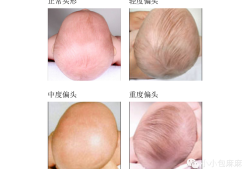 胎儿出生要几天（出生婴儿头骨未闭合怎么办？新生儿的头骨多久才会闭合呢）