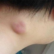 孕期淋巴发炎（孕期淋巴发炎对胎儿有影响吗）
