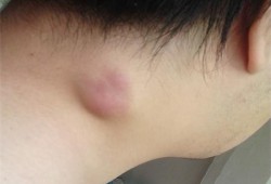 孕期淋巴发炎（孕期淋巴发炎对胎儿有影响吗）