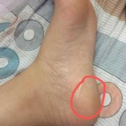 孕期脚疼（孕期脚疼）