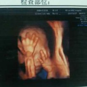 胎儿半握拳（胎儿半握拳状态是什么意思）