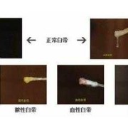 孕期白带发黄是什么原因（孕期分泌物颜色对照表）