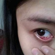 孕期眼睛发红（眼睛发红是什么病）
