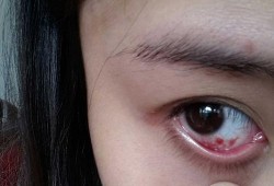 孕期眼睛发红（眼睛发红是什么病）