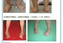 什么是胎儿足内翻,胎儿脚内翻是怎么回事