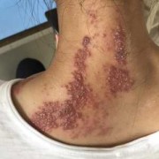 带状疱疹对胎儿的影响（带状疱疹对胎儿的影响）