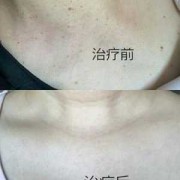 脖子长很多疣怎么办,孕期脖子长疣是什么原因造成的
