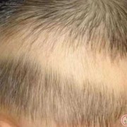三个月宝宝会脱发吗,胎儿会掉头发吗