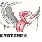 孕期子宫下垂图片（孕妇下坠感是什么感觉）