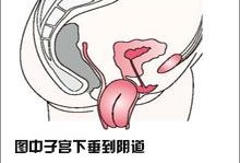 孕期子宫下垂图片（孕妇下坠感是什么感觉）
