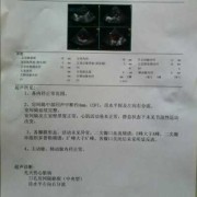胎儿背向右（八个月宝宝体检心脏彩超诊断结果说房间隔水平左向右分流）