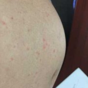 孕期肚子上长小红点（孕妇肚子上长了红点点，很痒，怎么办）