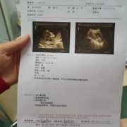 胎儿十二周发育图（12周胎心170正常吗）