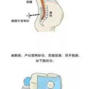 孕期麻醉（剖腹产先打麻药还是先插导尿管）