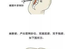 孕期麻醉（剖腹产先打麻药还是先插导尿管）