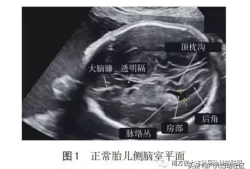 左侧侧脑室增宽是什么原因导致的,胎儿侧脑室增宽原因是什么