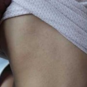八个月宝宝吃鸡蛋过敏了身上出现红疹怎么办，应该怎么处理才好,胎儿会过敏吗