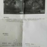 盆腔积液影响胎儿发育吗（盆腔积液影响胎儿发育吗女性）