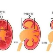 胎儿肾盂分离是什么意思,胎儿肾离合分离