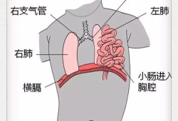 膈疝是怎么引起的,胎儿膈疝是什么原因造成的