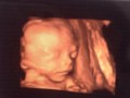 胎儿头偏大两周要紧吗（36周早产儿6斤6两是发育好了吗？之前产检显示胎儿偏大两周的）