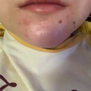 孕期下巴长痘是男孩吗（孕期下巴长痘是男孩吗）