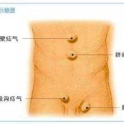 胎儿腹腔积水（腹腔积水该怎么治疗）