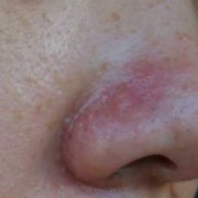 孕妇鼻子发炎可以涂红霉素眼膏吗,孕期鼻翼长痘是什么原因
